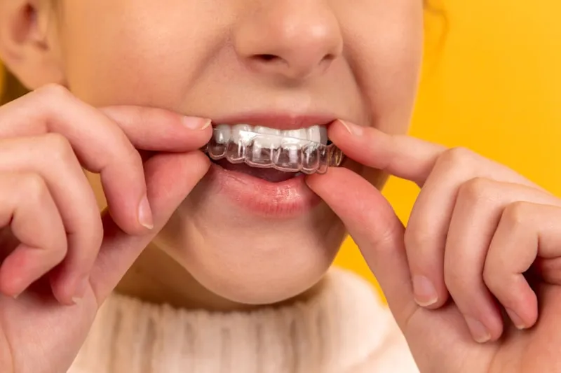 Dental Implants vs Bridges: Which Is the Better Choice?